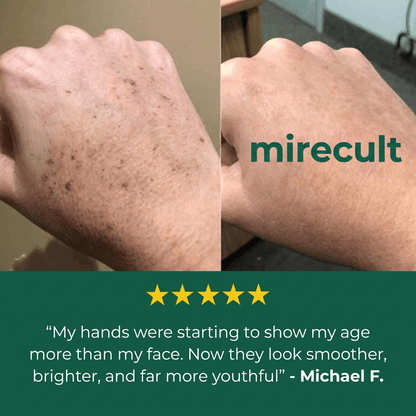 mirecult ™ Age Spot Cream 🔥Visibly diminishes the look of freckles.