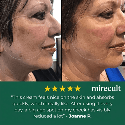 mirecult ™ Age Spot Cream 🔥Visibly diminishes the look of freckles.